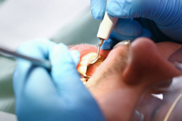 Best Emergency Tooth Extraction in Greensboro, AL